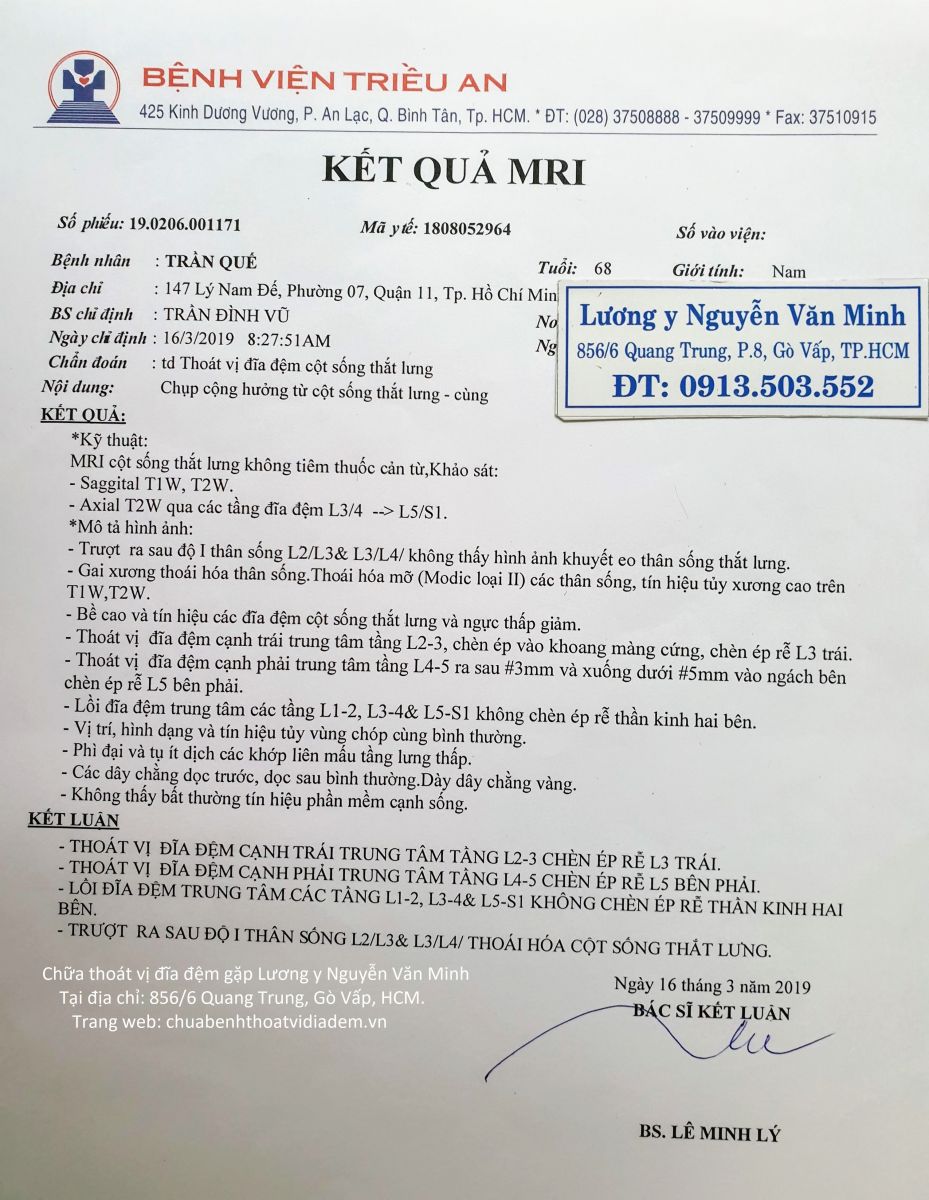 Thoát vị đĩa đệm chèn dây thần kinh